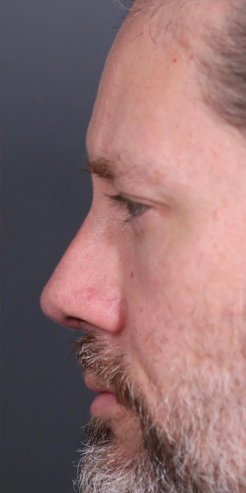 Primary Rhinoplasty Before & After Gallery - Patient 149051202 - Image 4