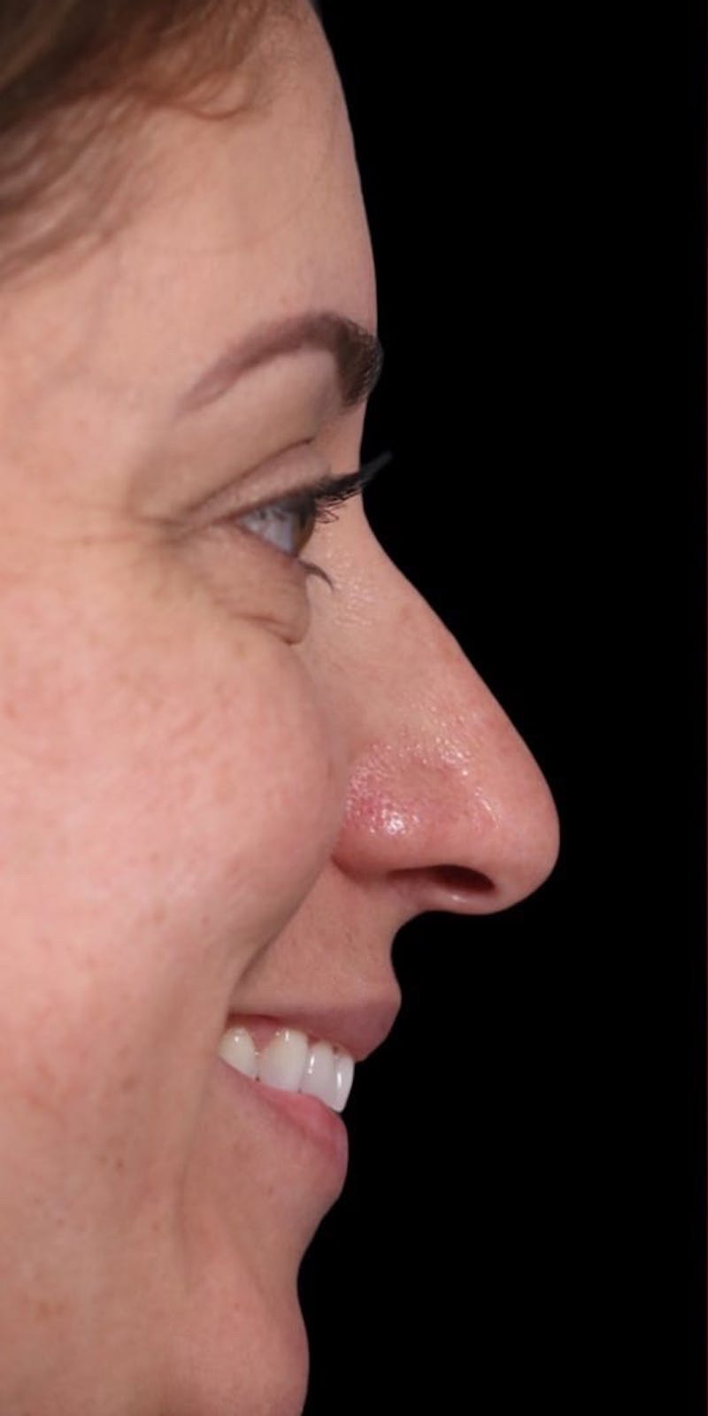 Primary Rhinoplasty Before & After Gallery - Patient 149051204 - Image 1