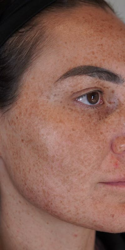 Moxi Laser Before & After Gallery - Patient 149097187 - Image 1