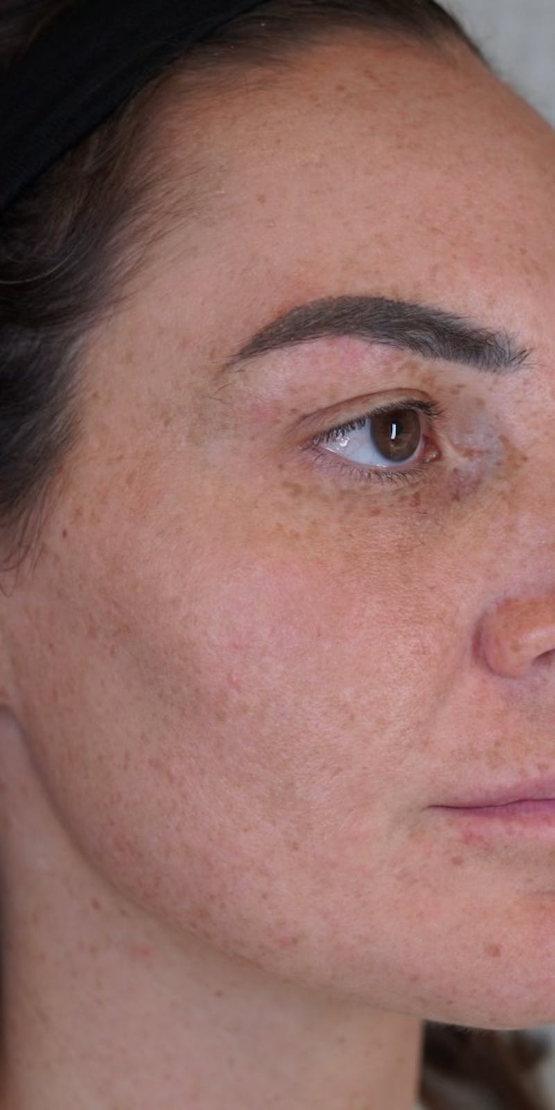 Moxi Laser Before & After Gallery - Patient 149097187 - Image 2