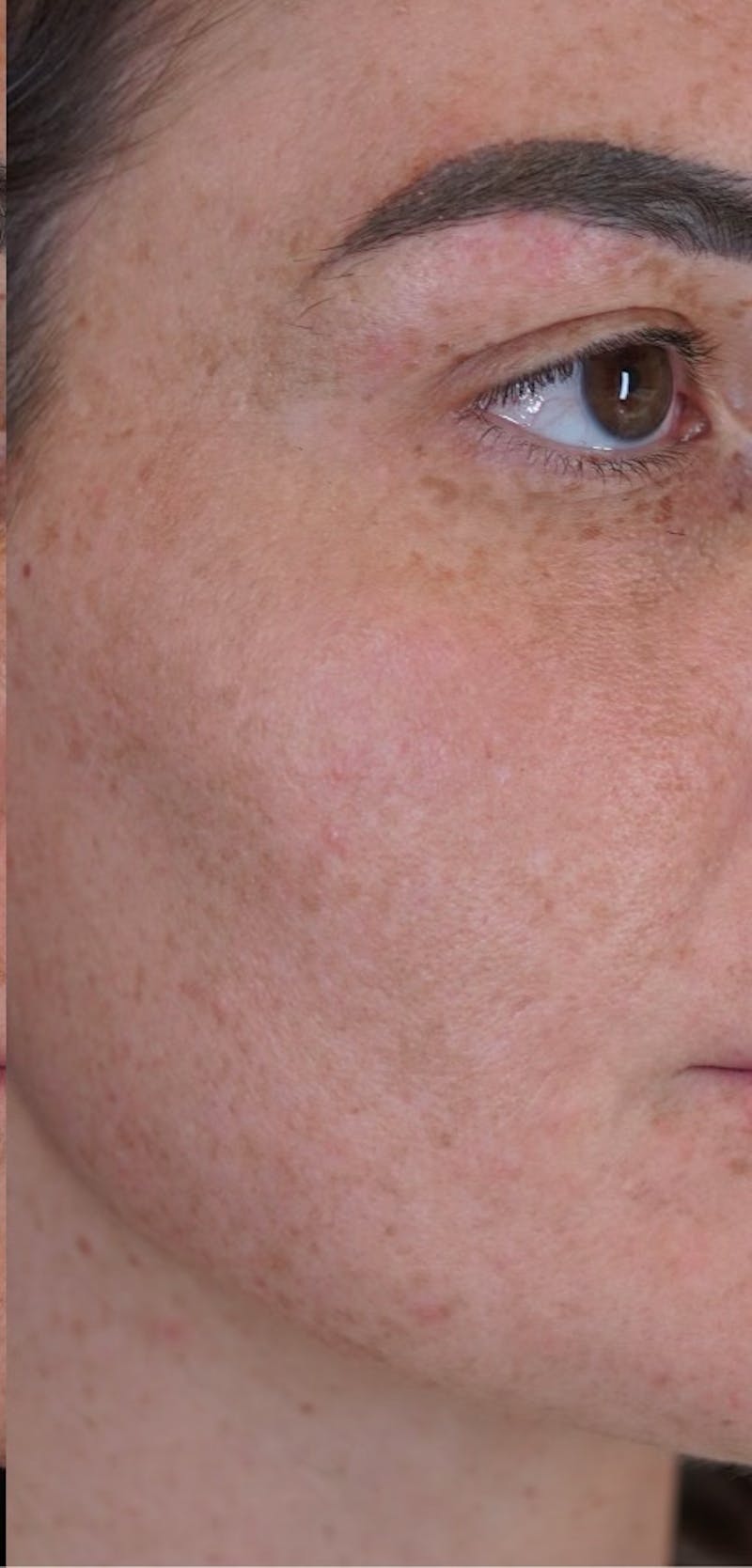 Moxi Laser Before & After Gallery - Patient 149097187 - Image 4