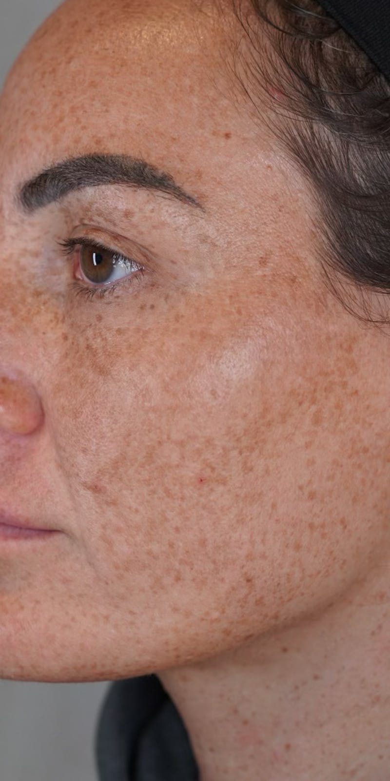 Moxi Laser Before & After Gallery - Patient 149097187 - Image 5