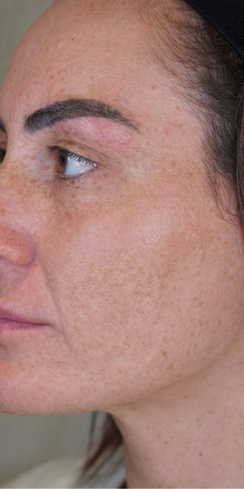 Moxi Laser Before & After Gallery - Patient 149097187 - Image 6