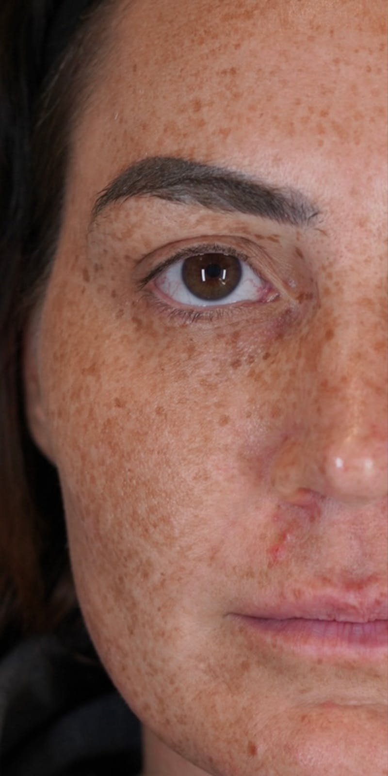 Moxi Laser Before & After Gallery - Patient 149097187 - Image 7