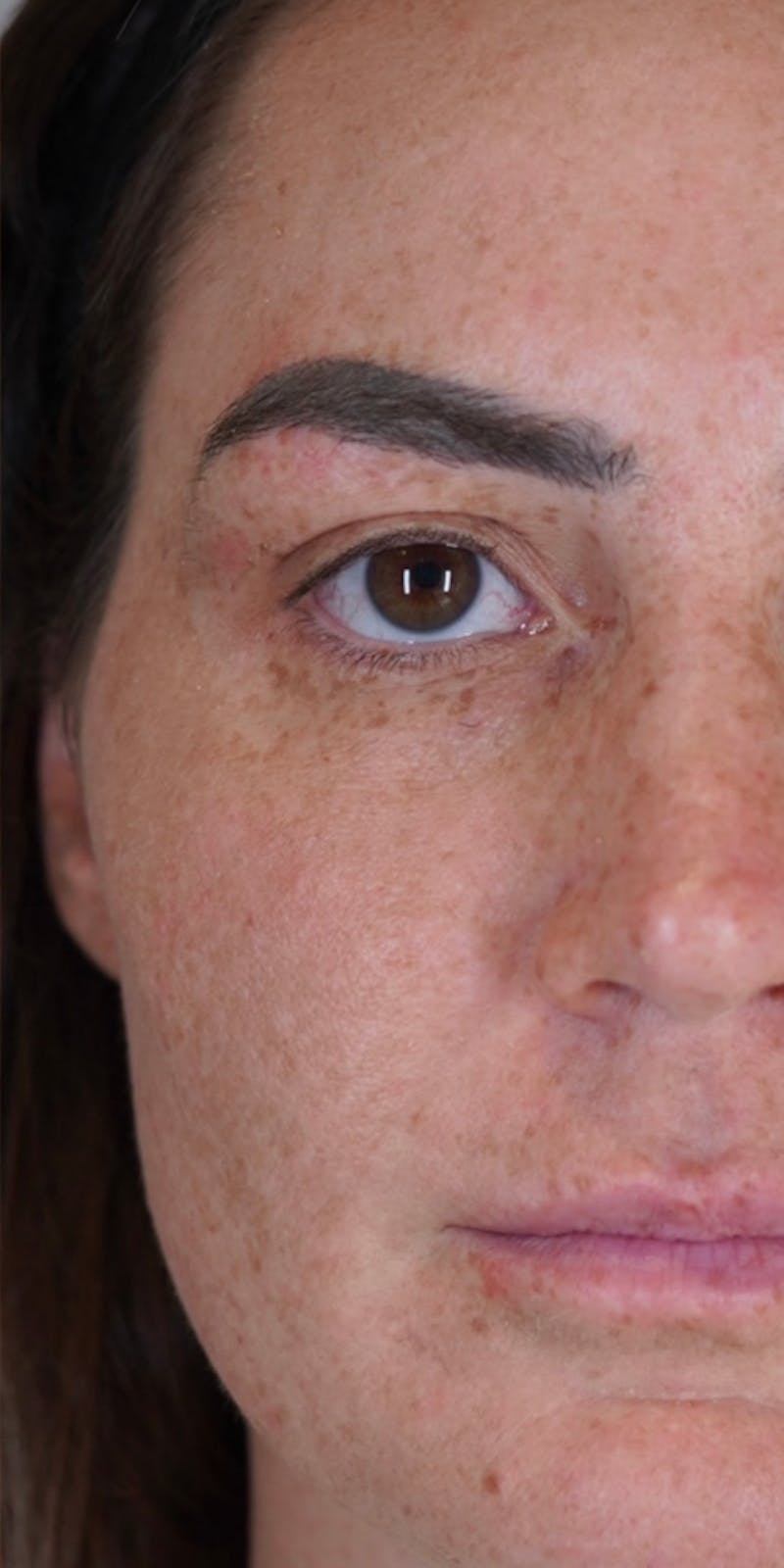 Moxi Laser Before & After Gallery - Patient 149097187 - Image 8