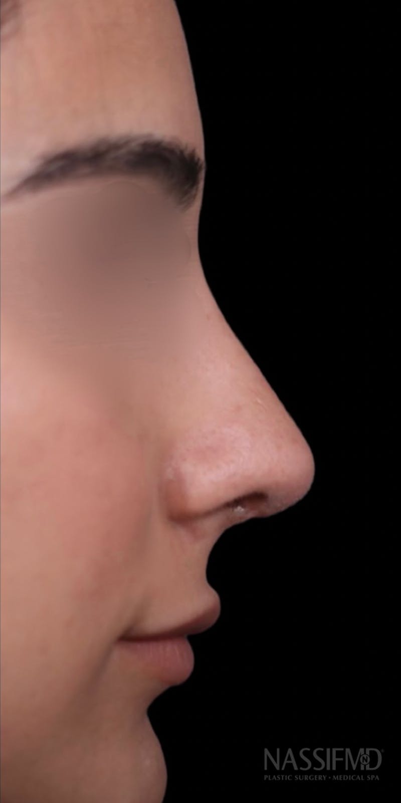 Revision Rhinoplasty Before & After Gallery - Patient 154360931 - Image 2