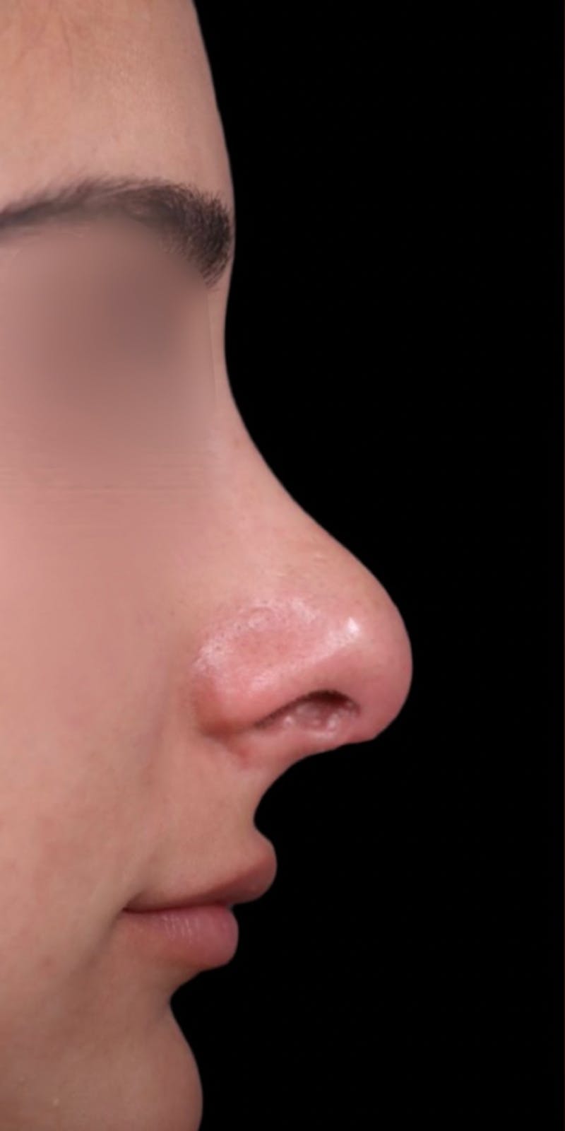 Revision Rhinoplasty Before & After Gallery - Patient 154360931 - Image 1