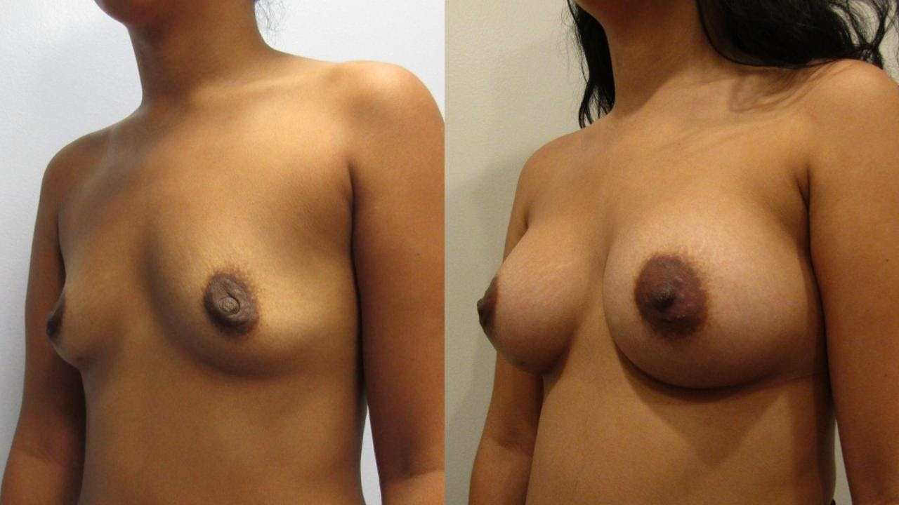 Breast Augmentation Before & After Gallery - Patient 175073842 - Image 2