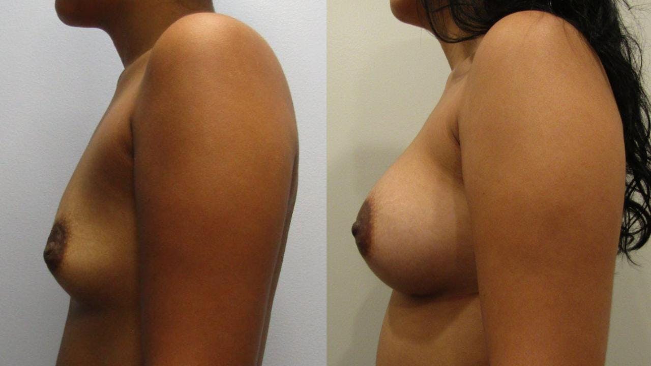Breast Augmentation Before & After Gallery - Patient 175073842 - Image 3