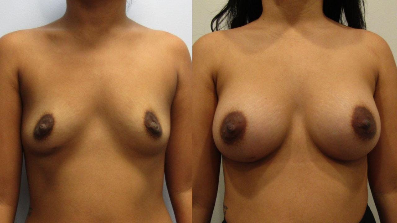 Breast Augmentation Before & After Gallery - Patient 175073842 - Image 1