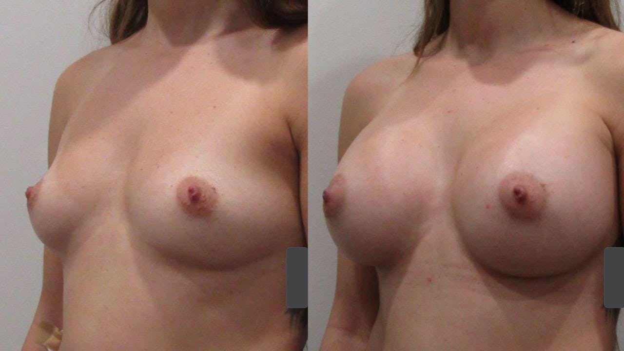 Breast Augmentation Before & After Gallery - Patient 175073843 - Image 2