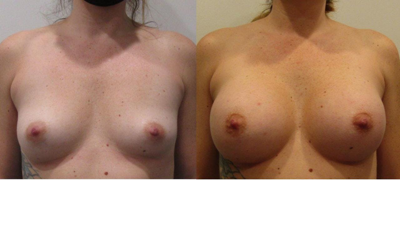 Breast Augmentation Before & After Gallery - Patient 175073844 - Image 1