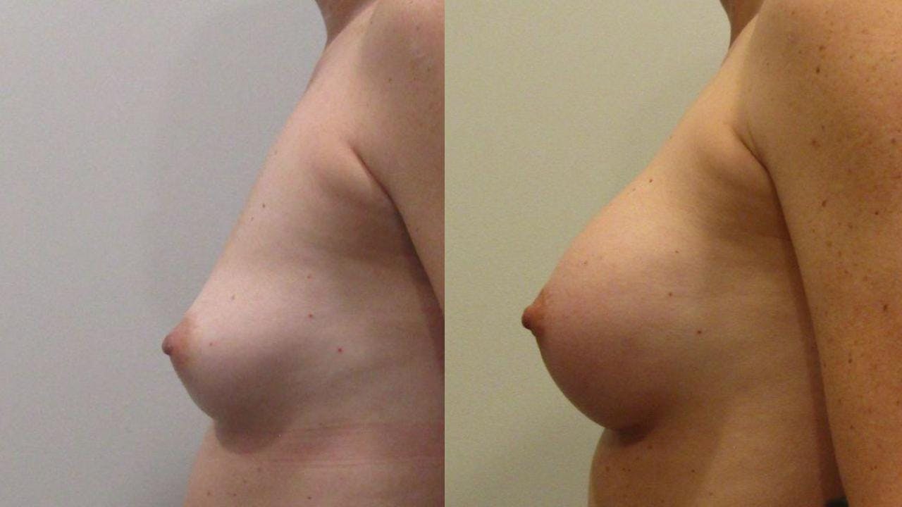 Breast Augmentation Before & After Gallery - Patient 175073844 - Image 2