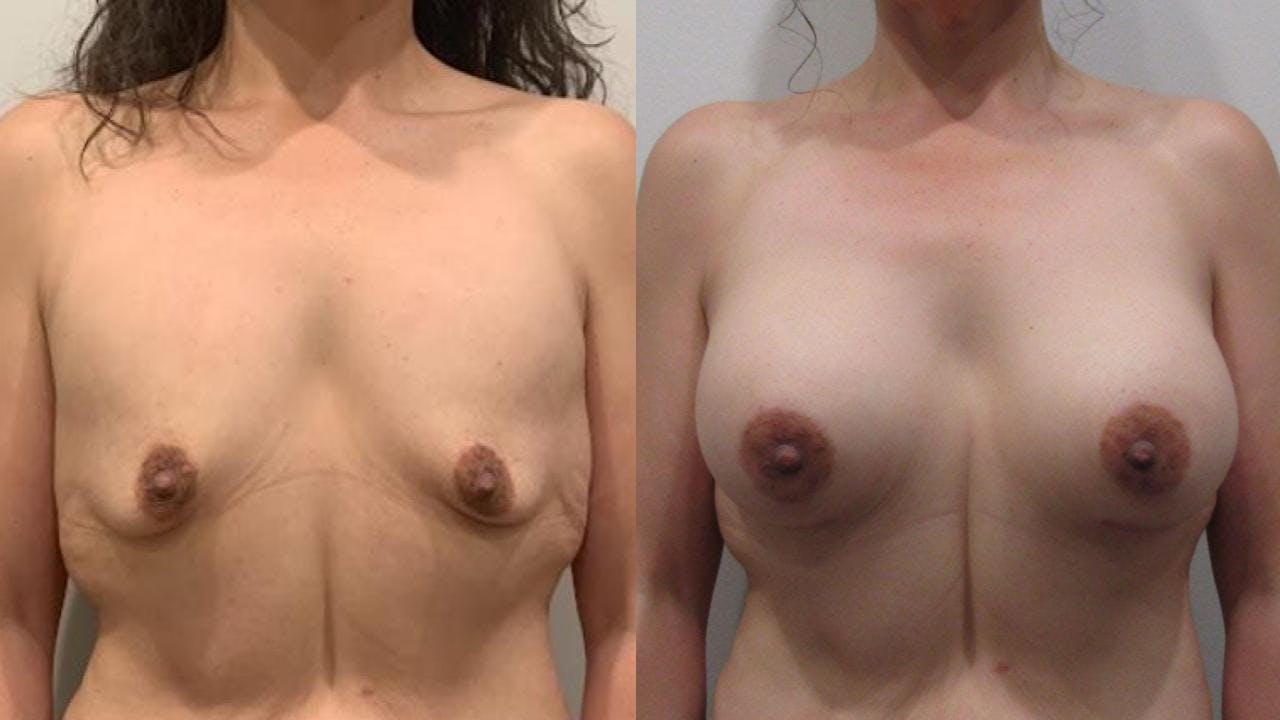 Breast Augmentation Before & After Gallery - Patient 175073845 - Image 1