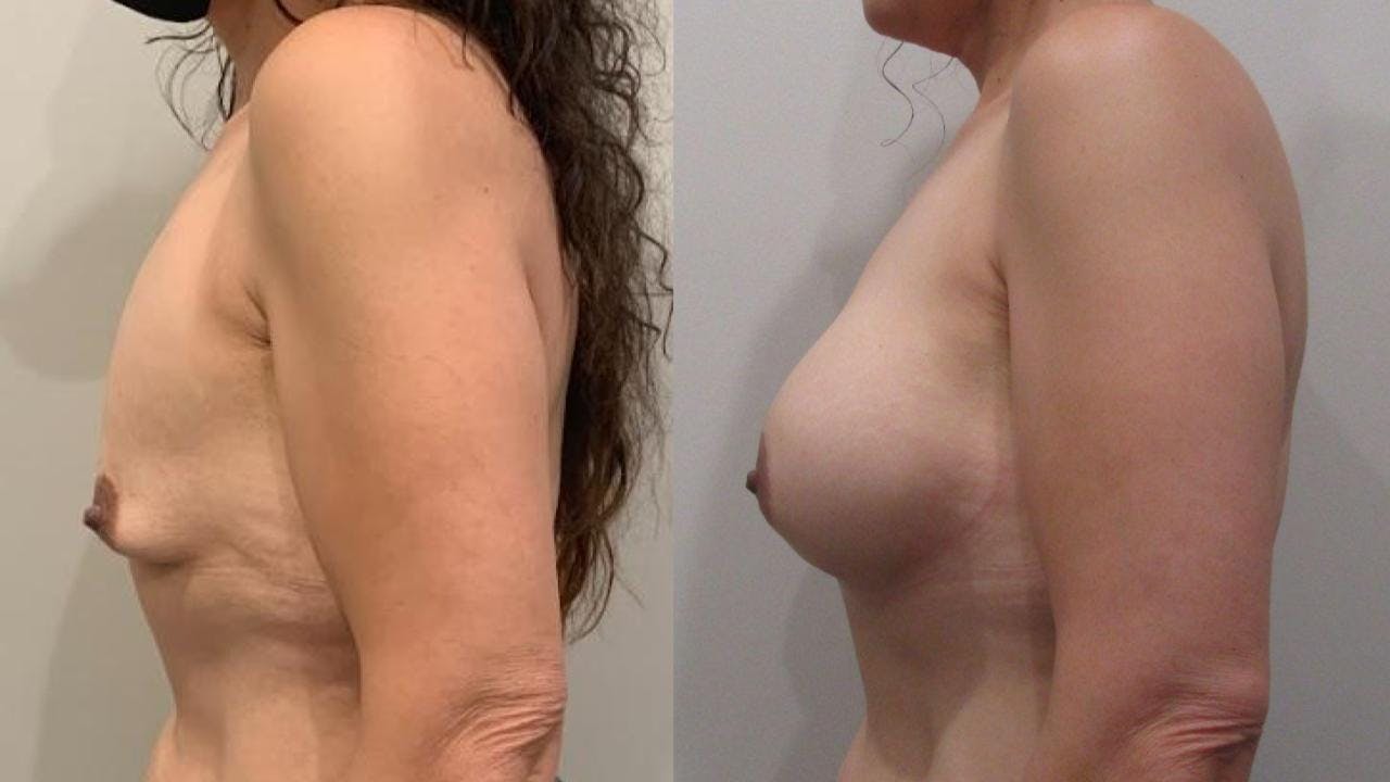 Breast Augmentation Before & After Gallery - Patient 175073845 - Image 2