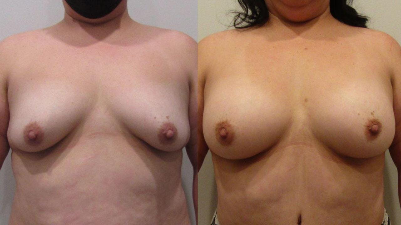 Breast Augmentation Before & After Gallery - Patient 175073846 - Image 1