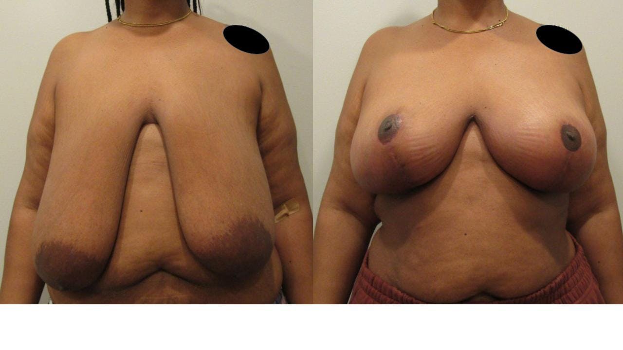 Breast Lift and Breast Reduction Before & After Gallery - Patient 175074258 - Image 1