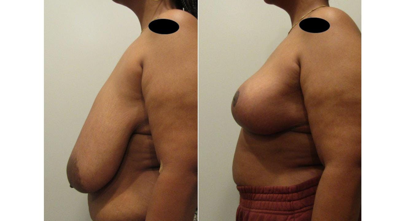Breast Lift and Breast Reduction Before & After Gallery - Patient 175074258 - Image 2
