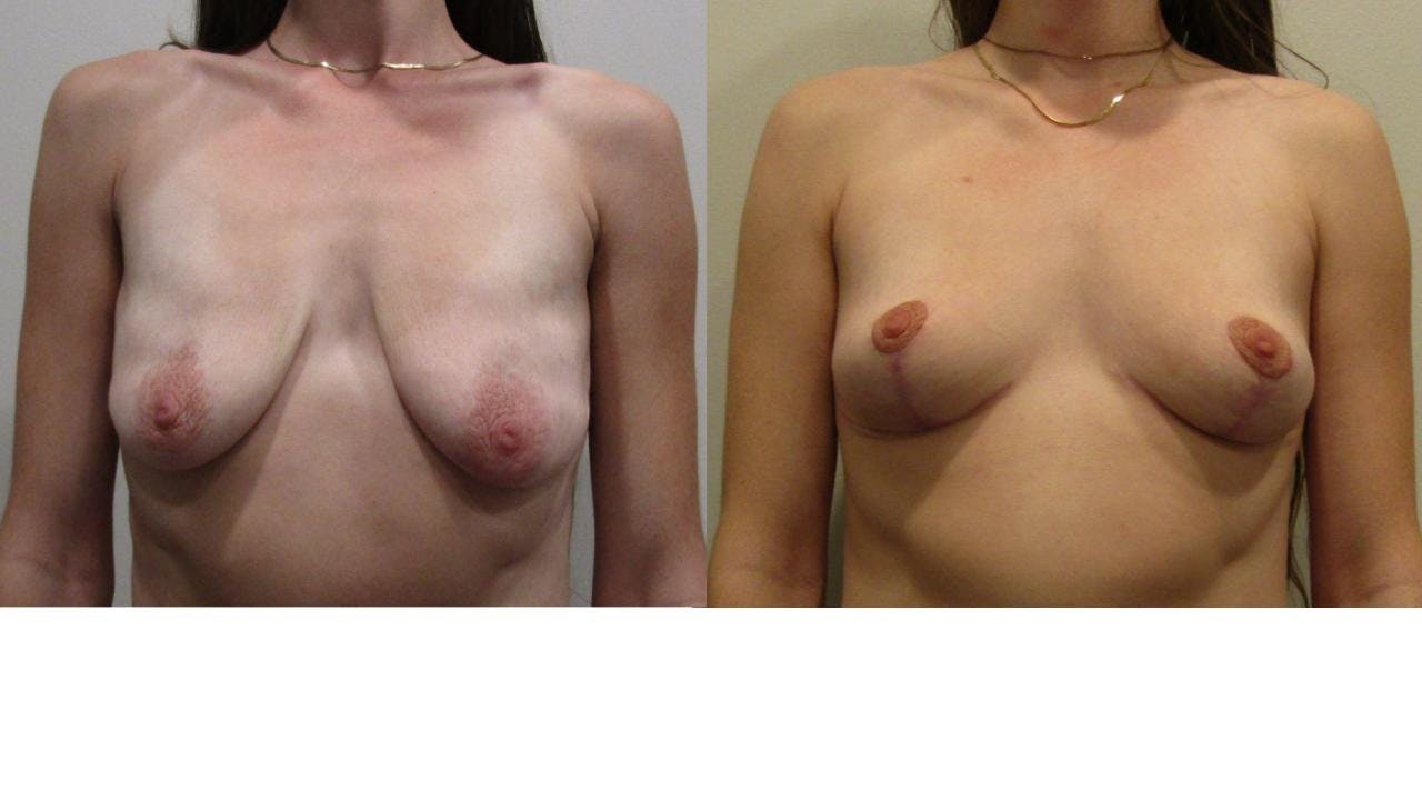 Breast Lift and Breast Reduction Before & After Gallery - Patient 175074302 - Image 1