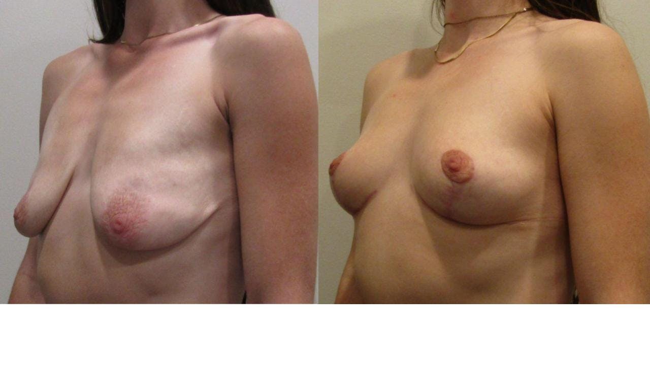 Breast Lift and Breast Reduction Before & After Gallery - Patient 175074302 - Image 2