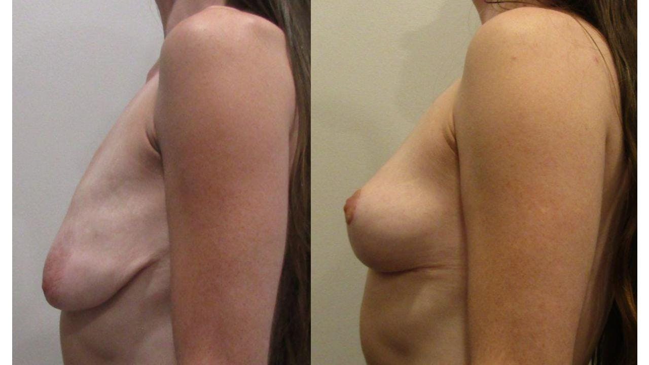 Breast Lift and Breast Reduction Before & After Gallery - Patient 175074302 - Image 3