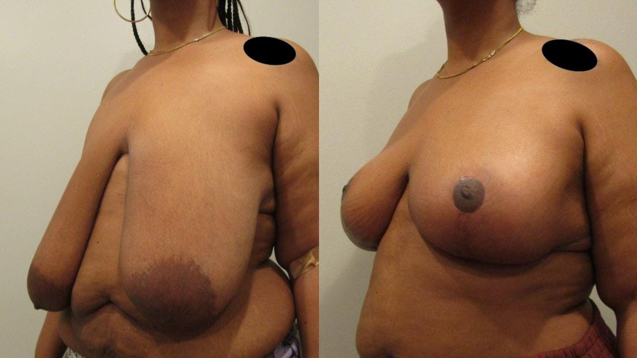 Breast Lift and Breast Reduction Before & After Gallery - Patient 175074258 - Image 3