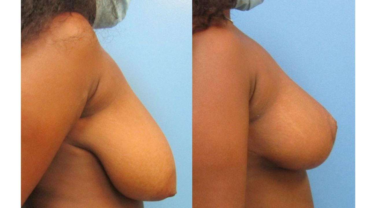 Breast Lift and Breast Reduction Before & After Gallery - Patient 175074352 - Image 1