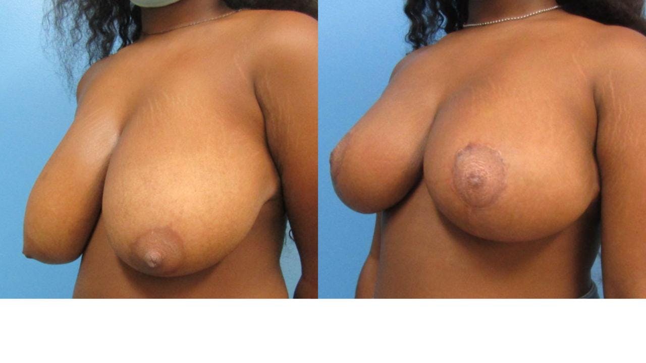 Breast Lift and Breast Reduction Before & After Gallery - Patient 175074354 - Image 1