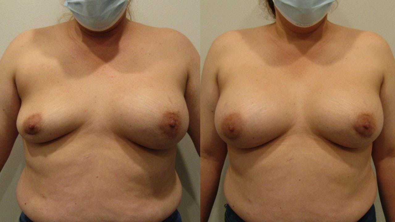 Breast Revision Before & After Gallery - Patient 175074357 - Image 1