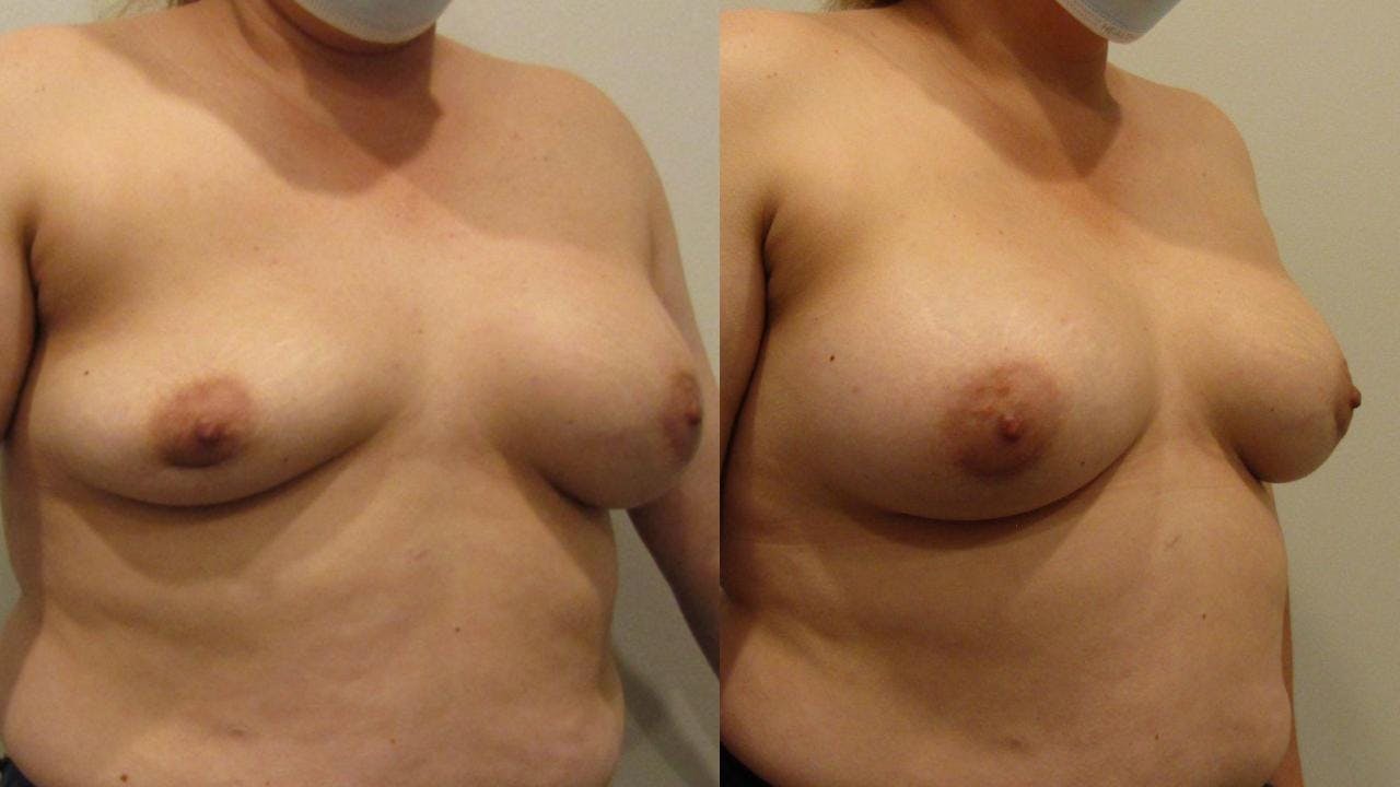 Breast Revision Before & After Gallery - Patient 175074357 - Image 2