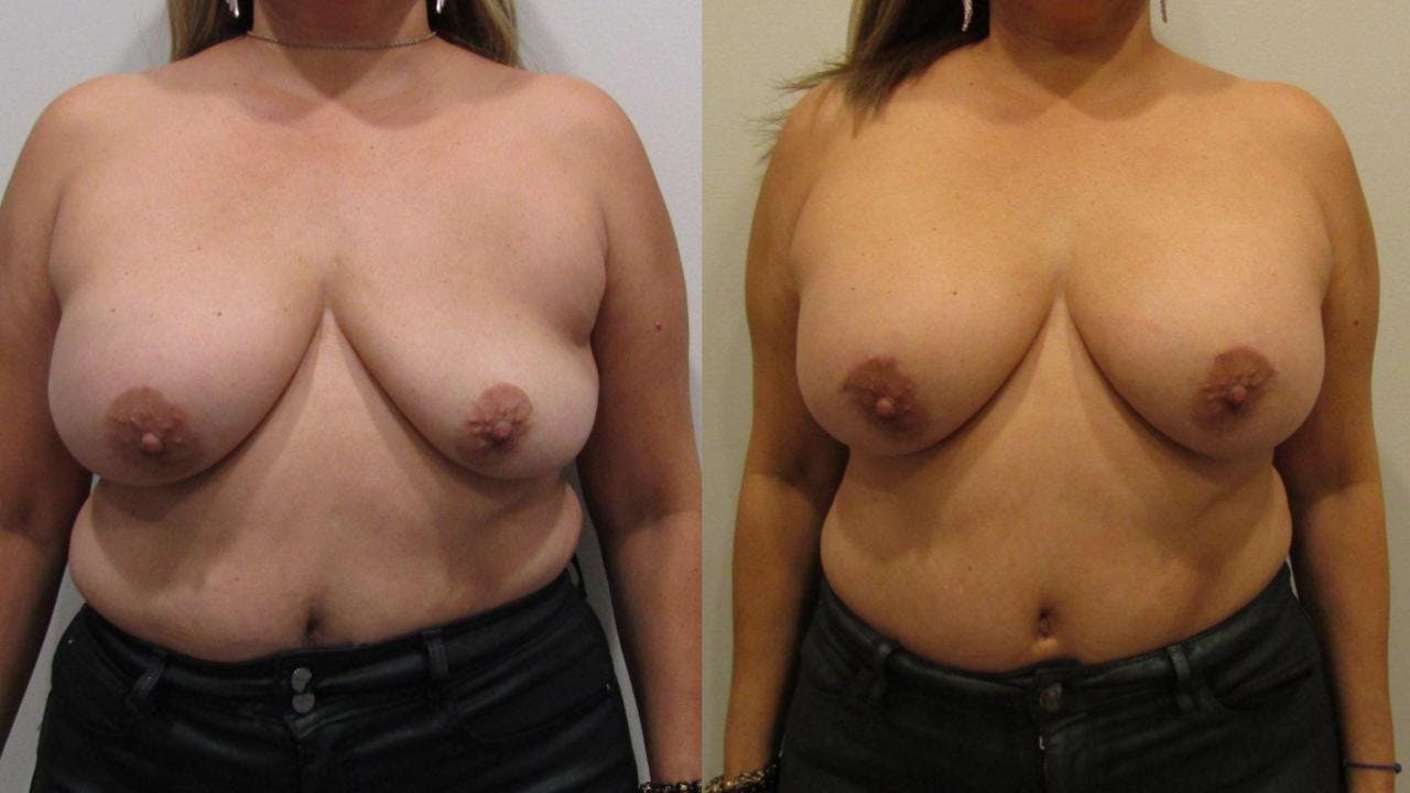 Breast Revision Before & After Gallery - Patient 175074358 - Image 1