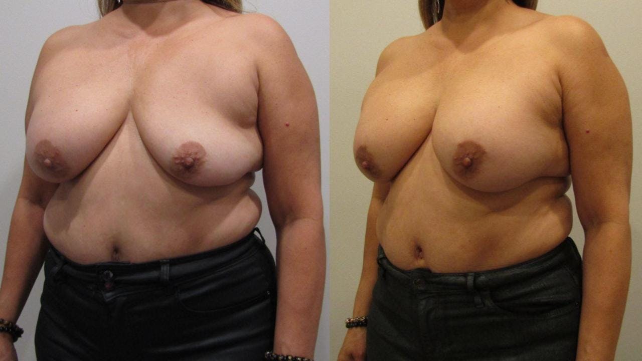 Breast Revision Before & After Gallery - Patient 175074358 - Image 2