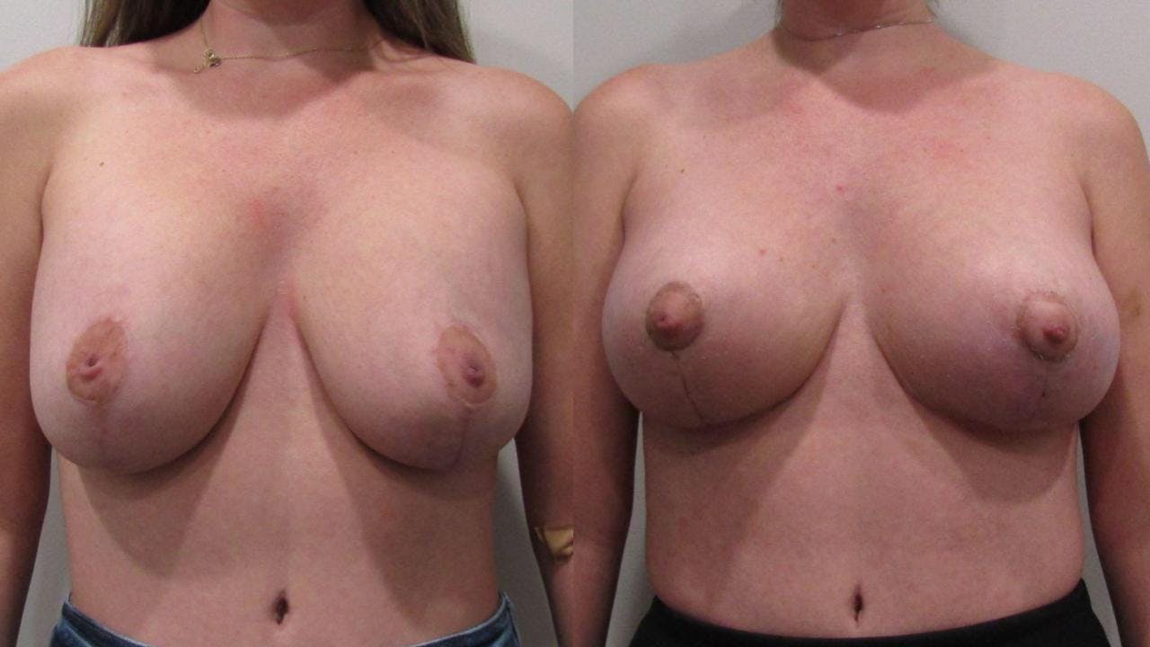 Breast Revision Before & After Gallery - Patient 175074360 - Image 1