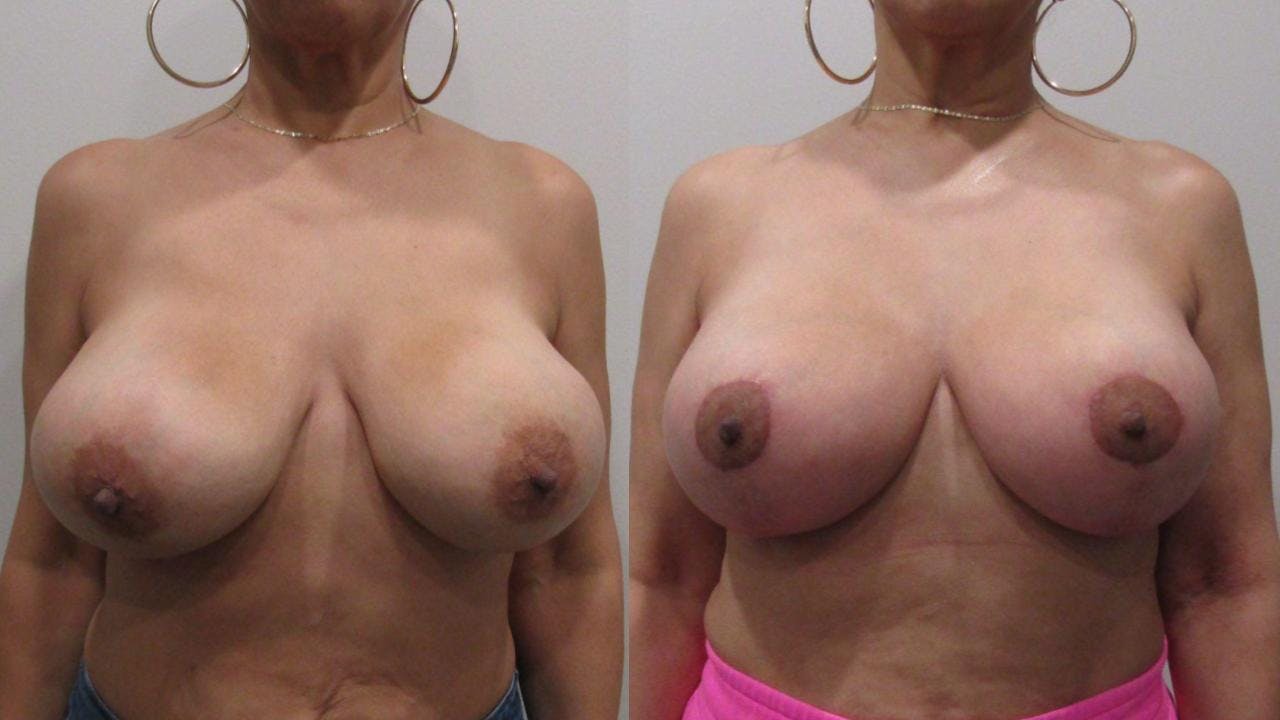 Breast Revision Before & After Gallery - Patient 175074359 - Image 1