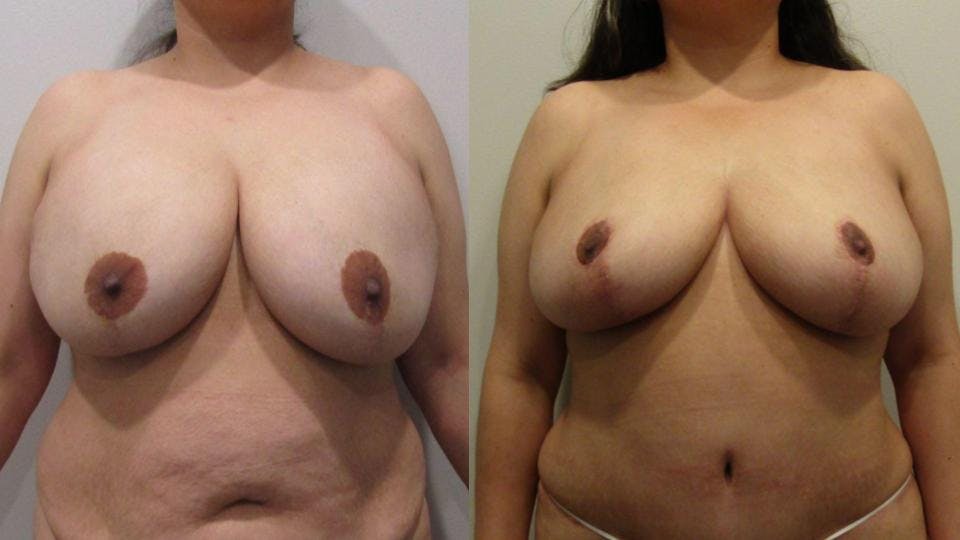 Implant Removal with Breast Lift  Before & After Gallery - Patient 175074727 - Image 1