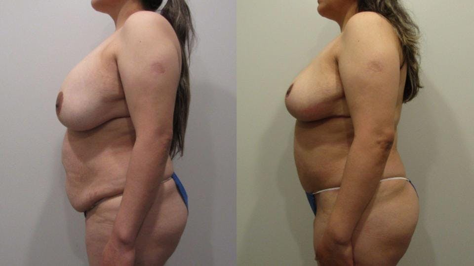 Implant Removal with Breast Lift  Before & After Gallery - Patient 175074727 - Image 3