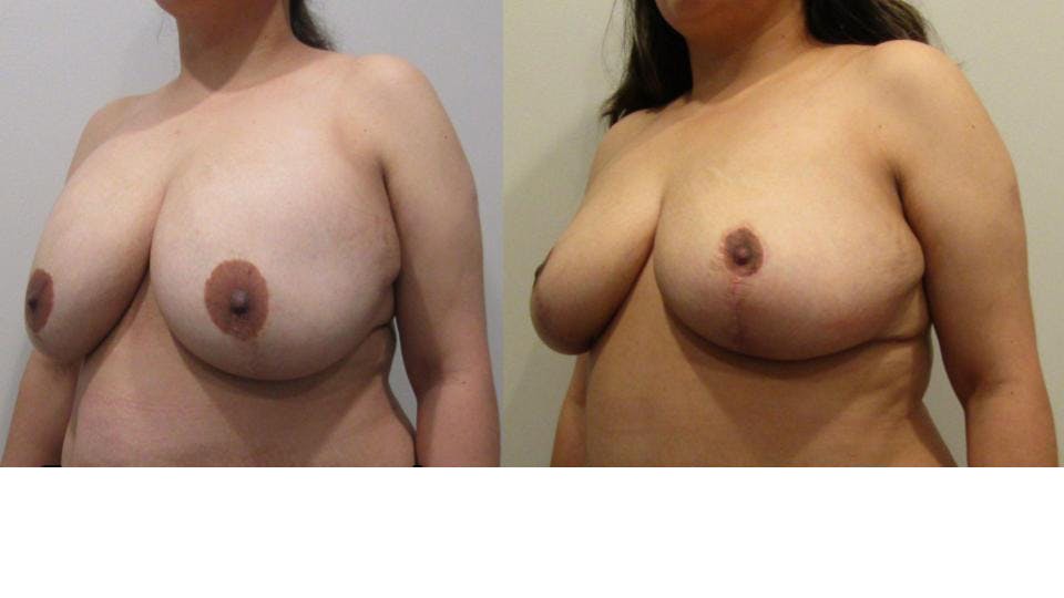 Implant Removal with Breast Lift  Before & After Gallery - Patient 175074727 - Image 2
