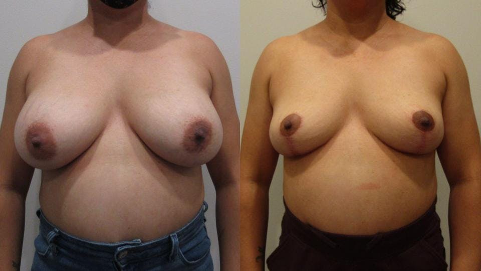 Implant Removal with Breast Lift  Before & After Gallery - Patient 175074728 - Image 1