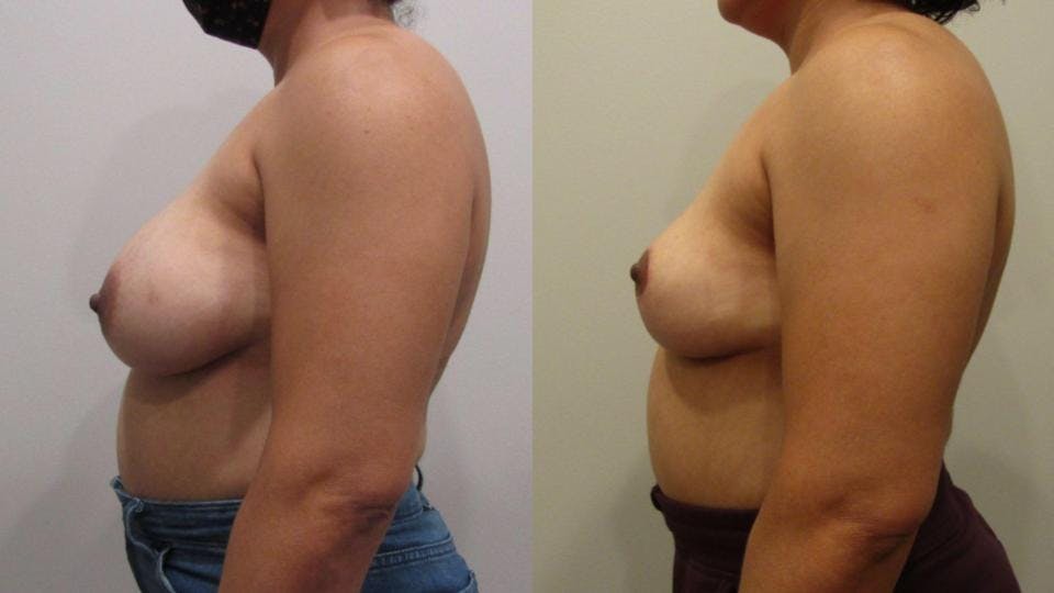 Implant Removal with Breast Lift  Before & After Gallery - Patient 175074728 - Image 2
