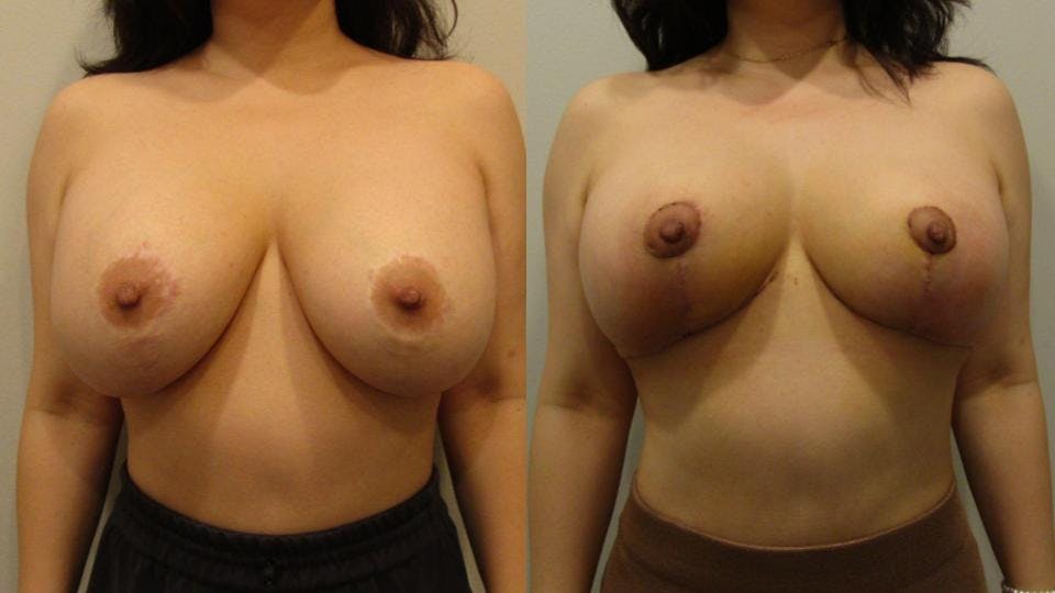 Implant Removal with Breast Lift  Before & After Gallery - Patient 175074729 - Image 1