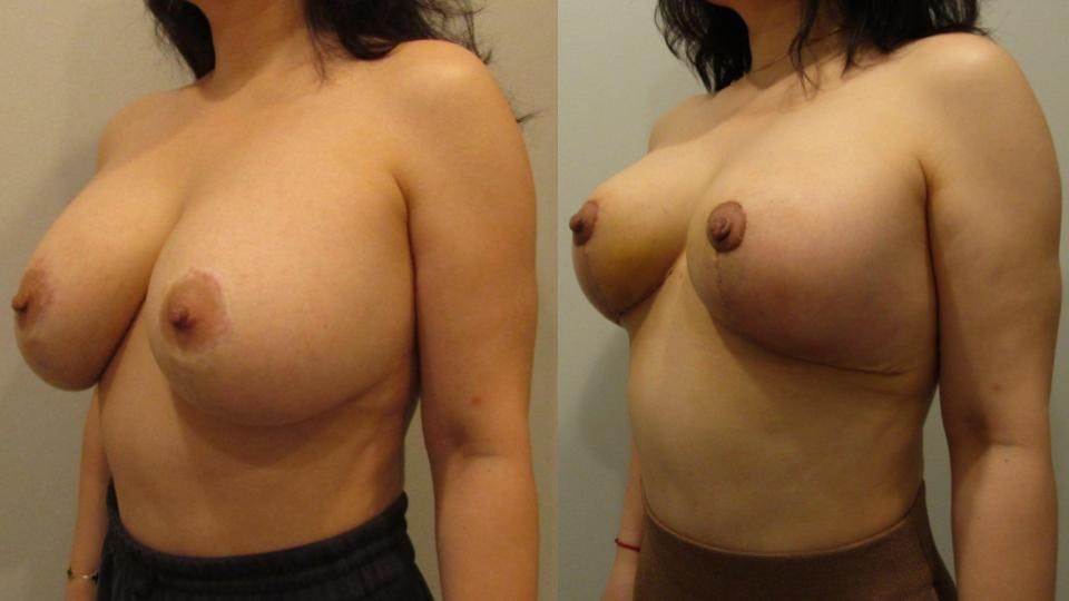 Implant Removal with Breast Lift  Before & After Gallery - Patient 175074729 - Image 2