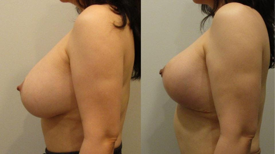 Implant Removal with Breast Lift  Before & After Gallery - Patient 175074729 - Image 3
