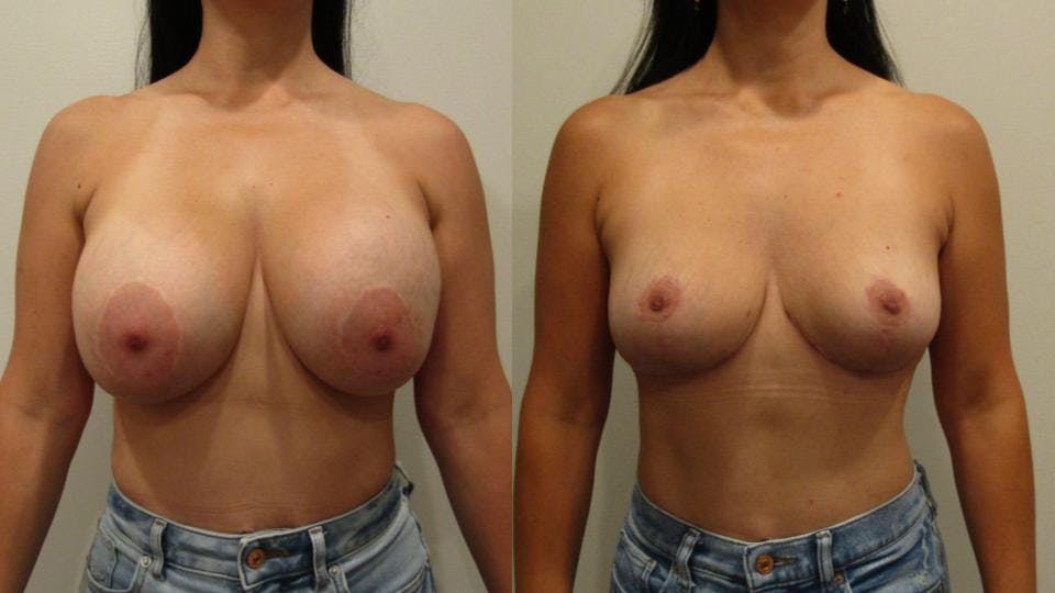 Implant Removal with Breast Lift  Before & After Gallery - Patient 175074730 - Image 1