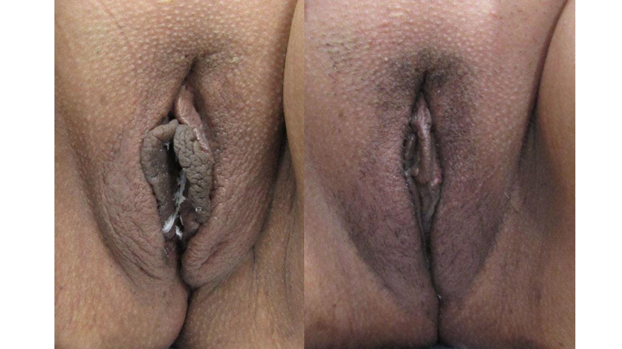 Labiaplasty Before & After Gallery - Patient 175074741 - Image 1