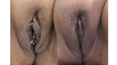 Labiaplasty Before & After Gallery - Patient 175074741 - Image 1