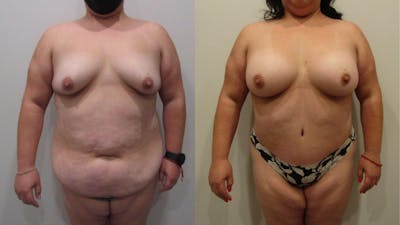 Mommy Makeover Before & After Gallery - Patient 175075293 - Image 1