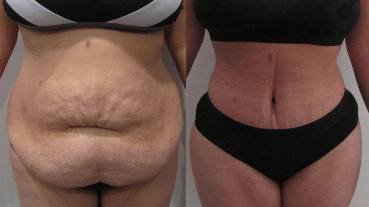 Tummy Tuck Before & After Gallery - Patient 175075309 - Image 1
