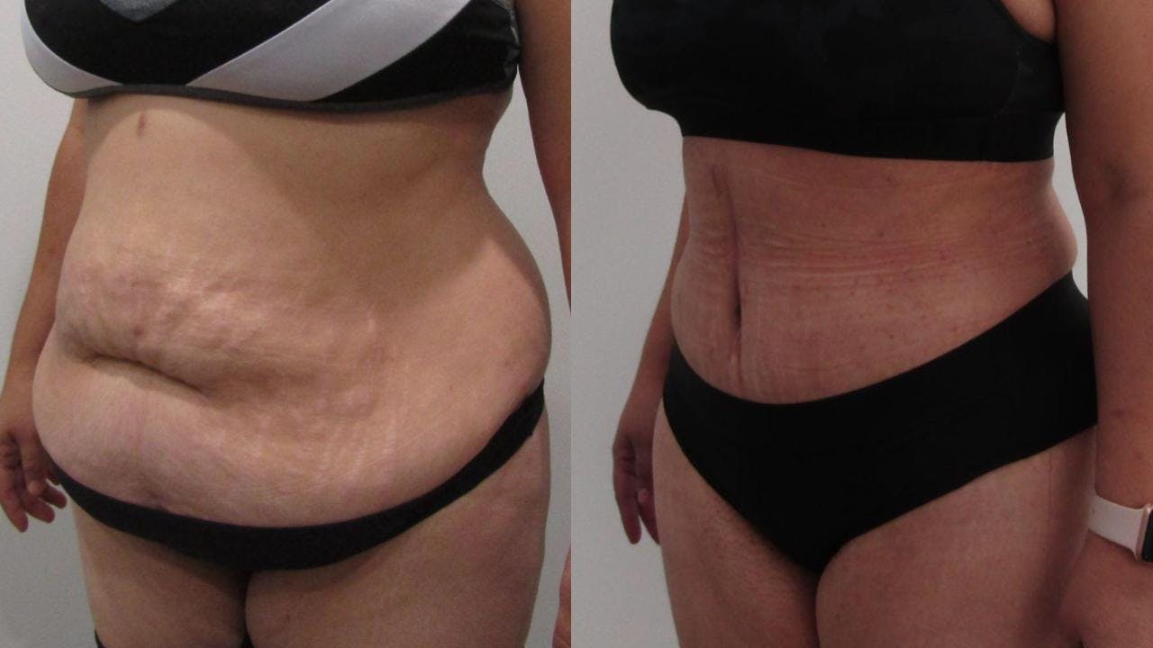 Tummy Tuck Before & After Gallery - Patient 175075309 - Image 2