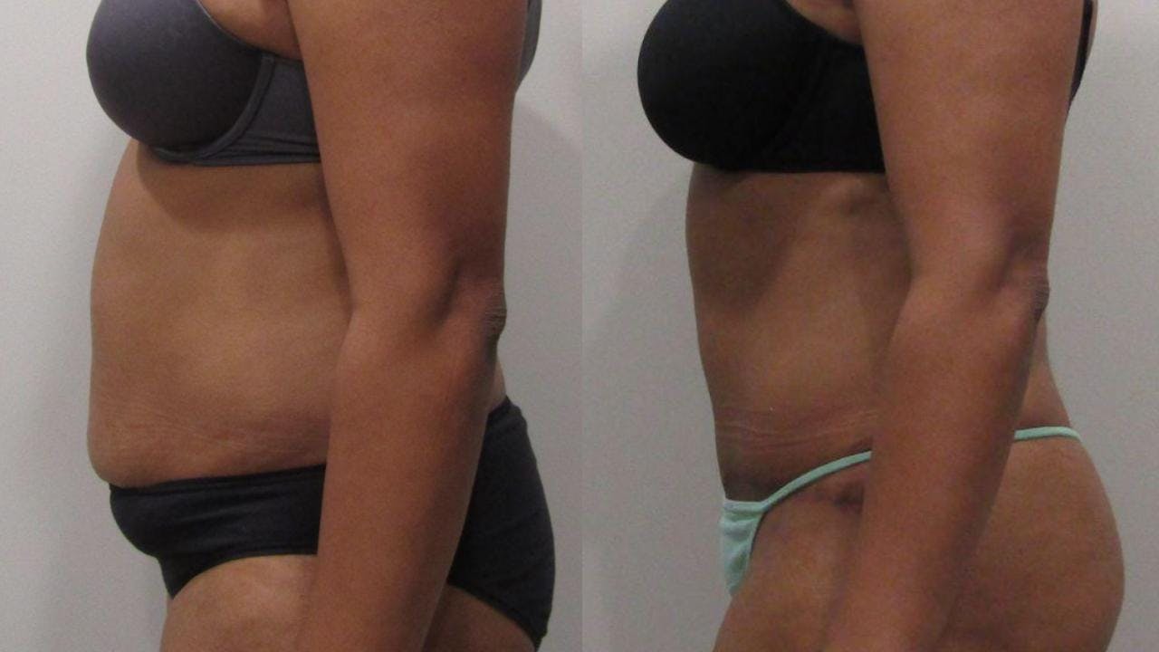 Tummy Tuck Before & After Gallery - Patient 175075310 - Image 2