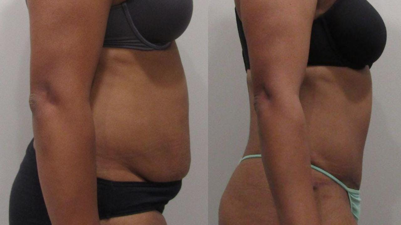Tummy Tuck Before & After Gallery - Patient 175075310 - Image 3